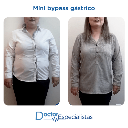 Mini bypass gastrico antes y despues