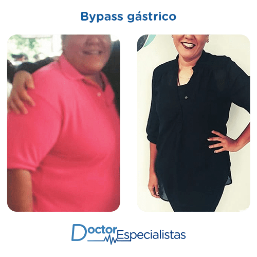 Bypass gastrico antes y despues
