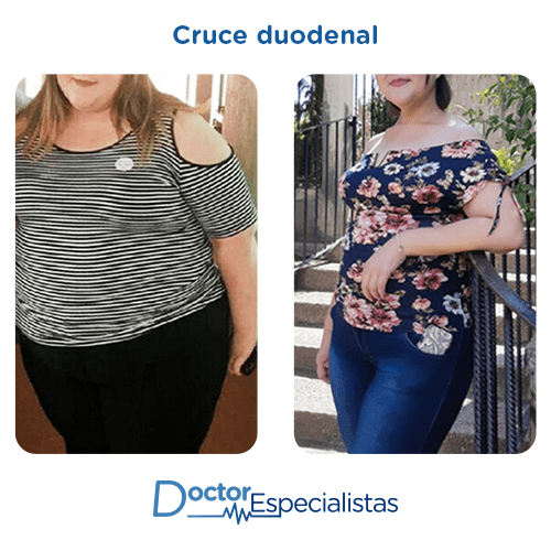 Cruce duodenal antes y despues