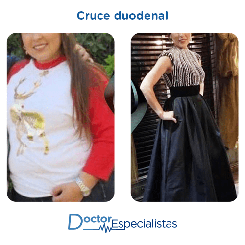 Cruce duodenal antes y despues