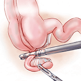 Imagen ilustrativa extracción de apendice