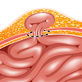 Imagen ilustrativa hernia