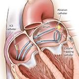 Imagen ilustrativa de Ablación Cardiaca
