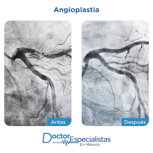 Angioplastia antes y despues