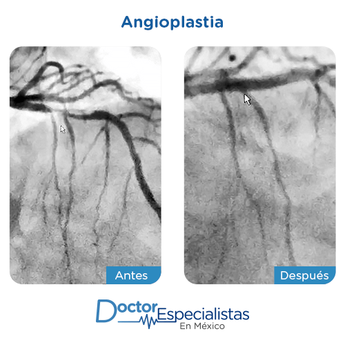 Angioplastia antes y despues