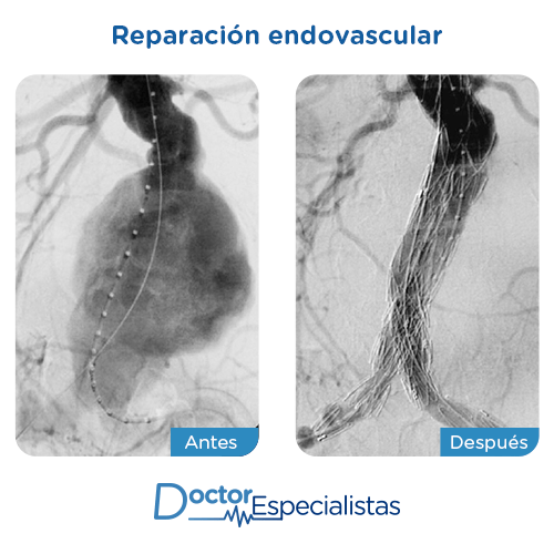 Reparacion endovascular antes y despues