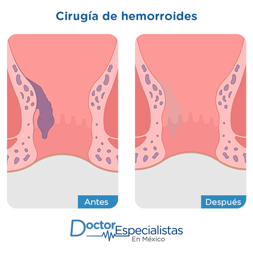 Hemorroidectomia antes y despues 