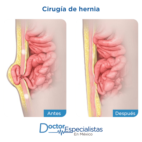 Cirugia de hernia antes y despues