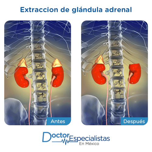 Extracción de glándula adrenal antes y despues