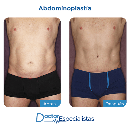 Abdominoplastia antes y despues