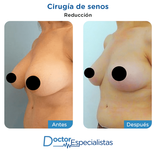 Cirugia de senos antes y despues