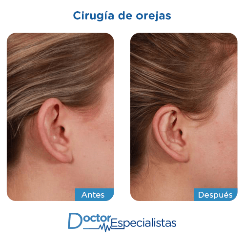 Cirugia de orejas antes y despues