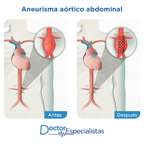Aneurisma aortico antes y despues 