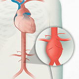 Aneurisma aortico