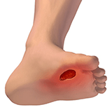 Ulceras del pie diabetico