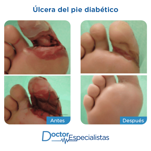 Ulceras del pie diabetico antes y despues