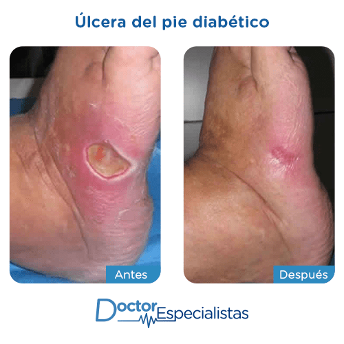 Ulceras del pie diabetico antes y despues