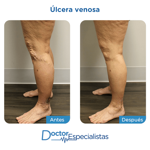 Ulcera venosa antes y despues