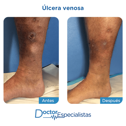Ulcera venosa antes y despues