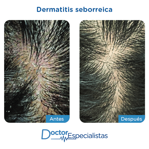 Dermatitis antes y despues