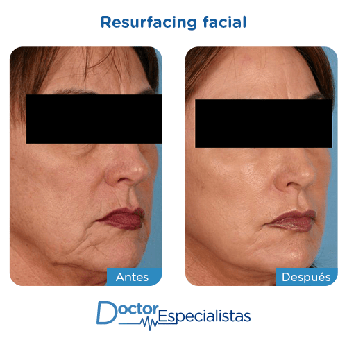 Resurfacing facial antes y despues