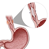 Imagen ilustrativa Dilatacion esofagica