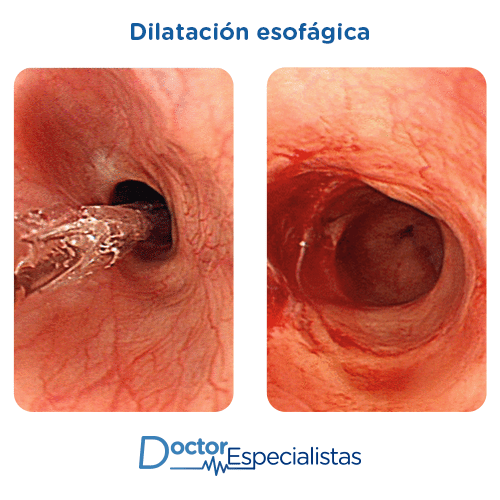 Dilatacion esofagica antes y despues