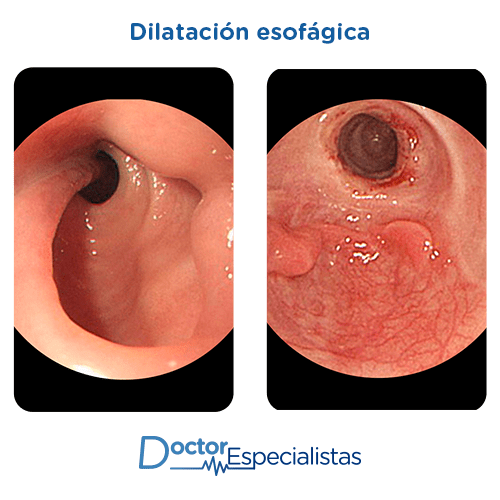 Dilatacion esofagica antes y despues