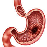 Imagen ilustrativa Sangrado gastrointestinal