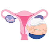 Imagen inlustrativa de estimulacion ovarica