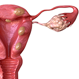 Imagen ilustrativa de endometriosis
