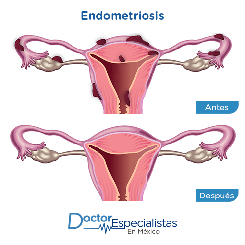 Endometriosis imagen ilustrativa