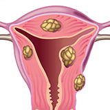 Imagen ilustrativa de miomas uterinos