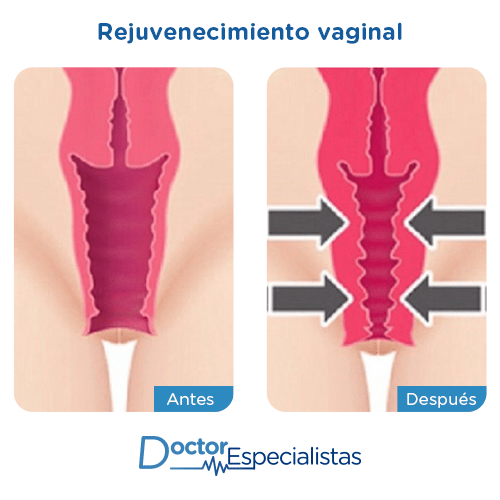 Rejuvenecimiento vaginal imagen ilustrativa