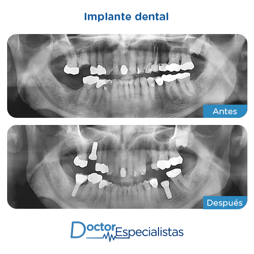 Implante dental antes y despues