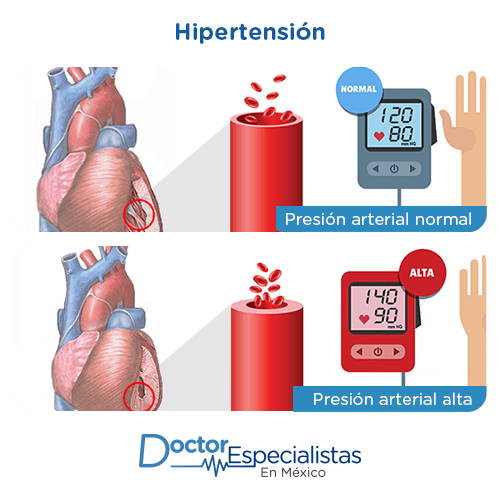 Medicina Interna Hipertension Antes Y Despues