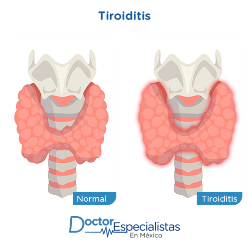 Medicina Interna Enfermedades de la tiroides Antes Y Despues