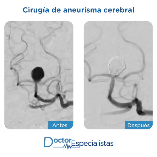 Cirugia aneurisma cerebral antes y despues