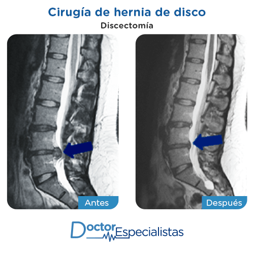 Cirugia hernia disco antes y despues