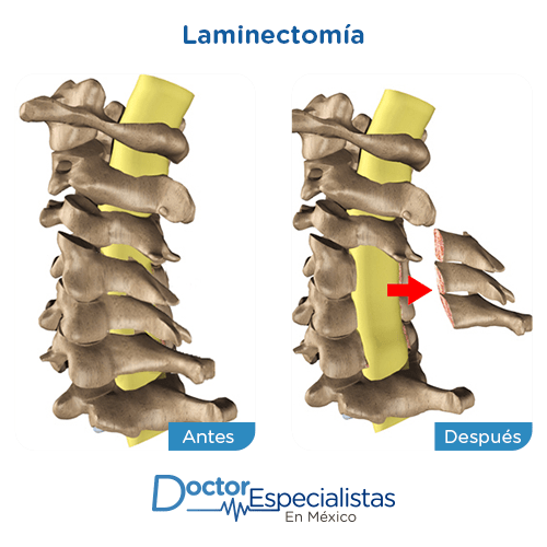 Laminectomia imagen ilustrativa