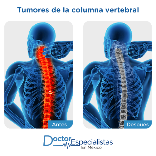 Tumores de la columna vertebral y espinales imagen ilustrativa