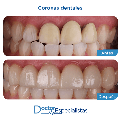 Corona dental antes y despues