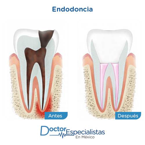 Endodoncia imagen ilustrativa
