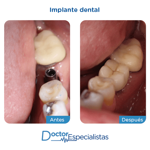Implantes dentales antes y despues