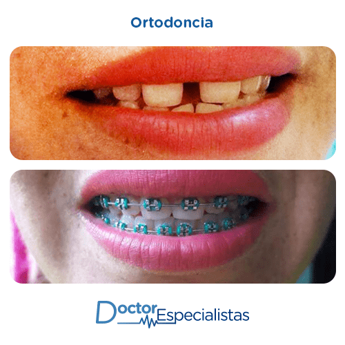 Ortodoncia antes y despues