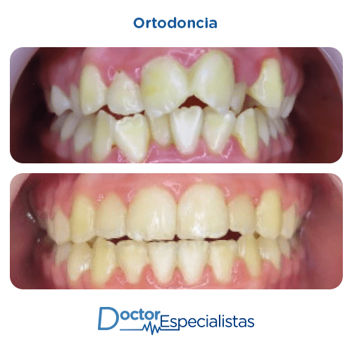 Ortodoncia antes y despues