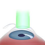 Imagen ilustrativa cirugia laser Lasik