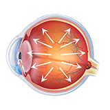 Imagen ilustrativa de glaucoma