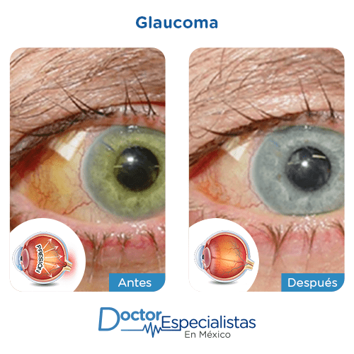 Cirugía de glaucoma imagen ilustrativa