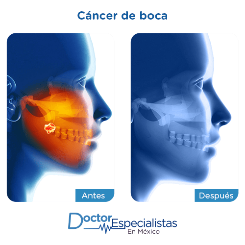 Cancer de boca imagen ilustrativa